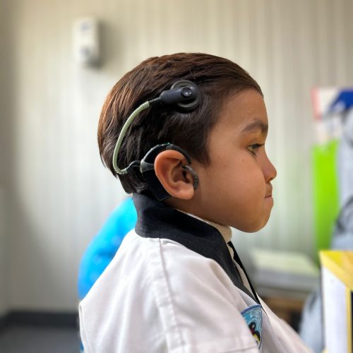 Abdullah cochlear implant (3) Abdullah cochlear implant (3)